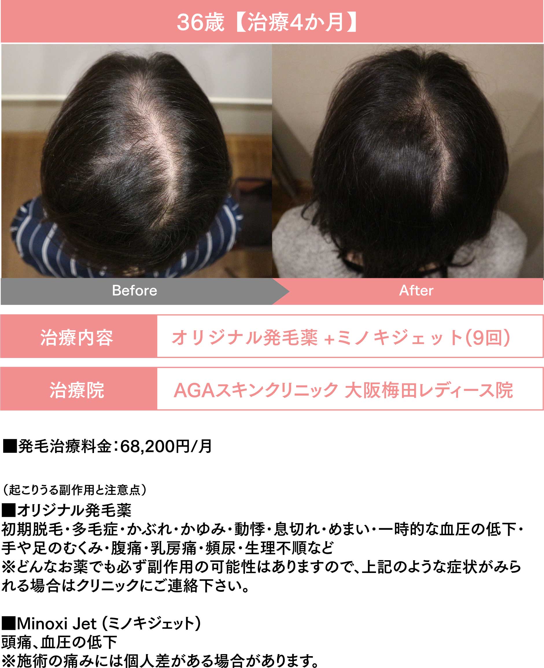 36歳【治療4か月】