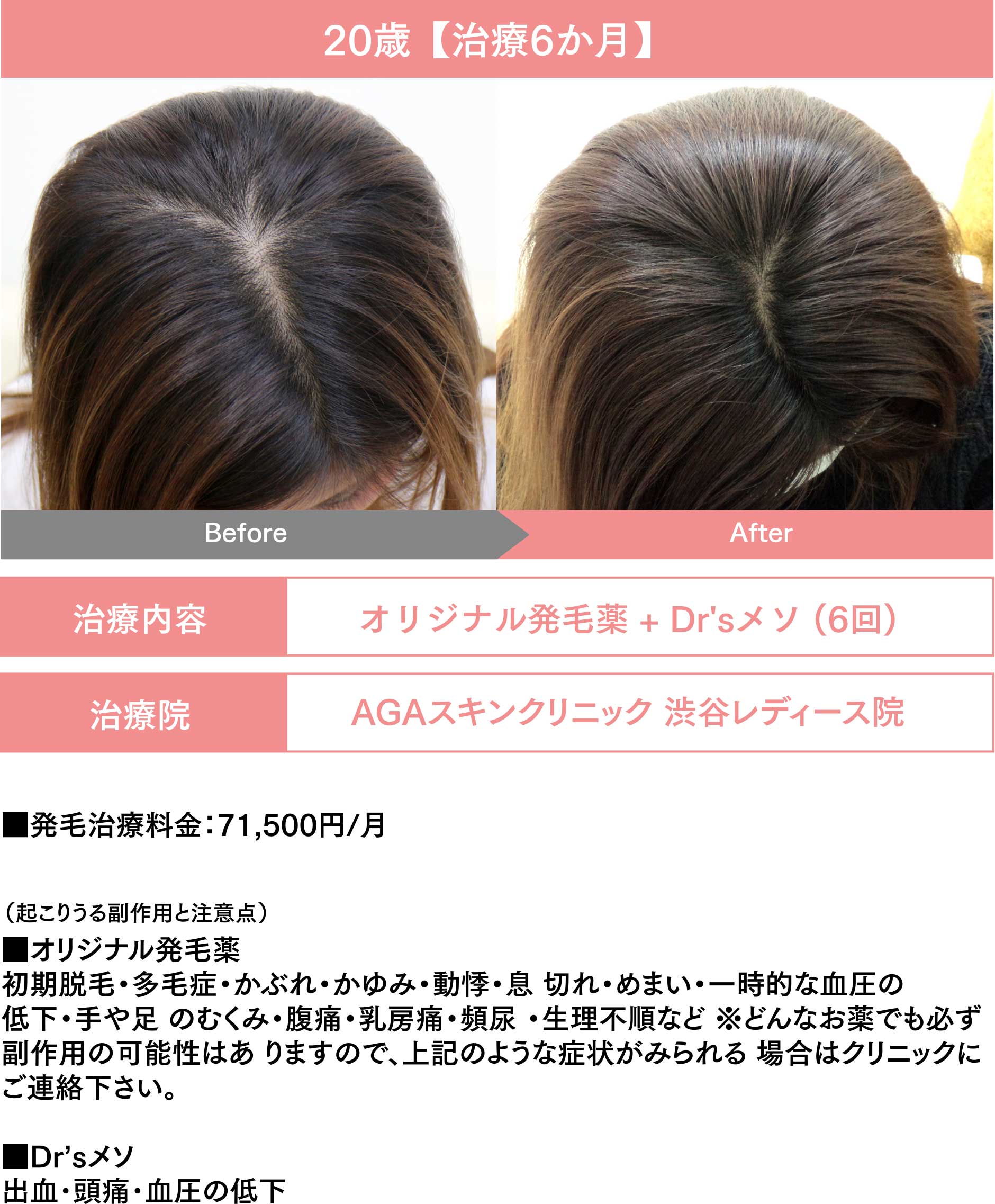 20歳【治療6か月】