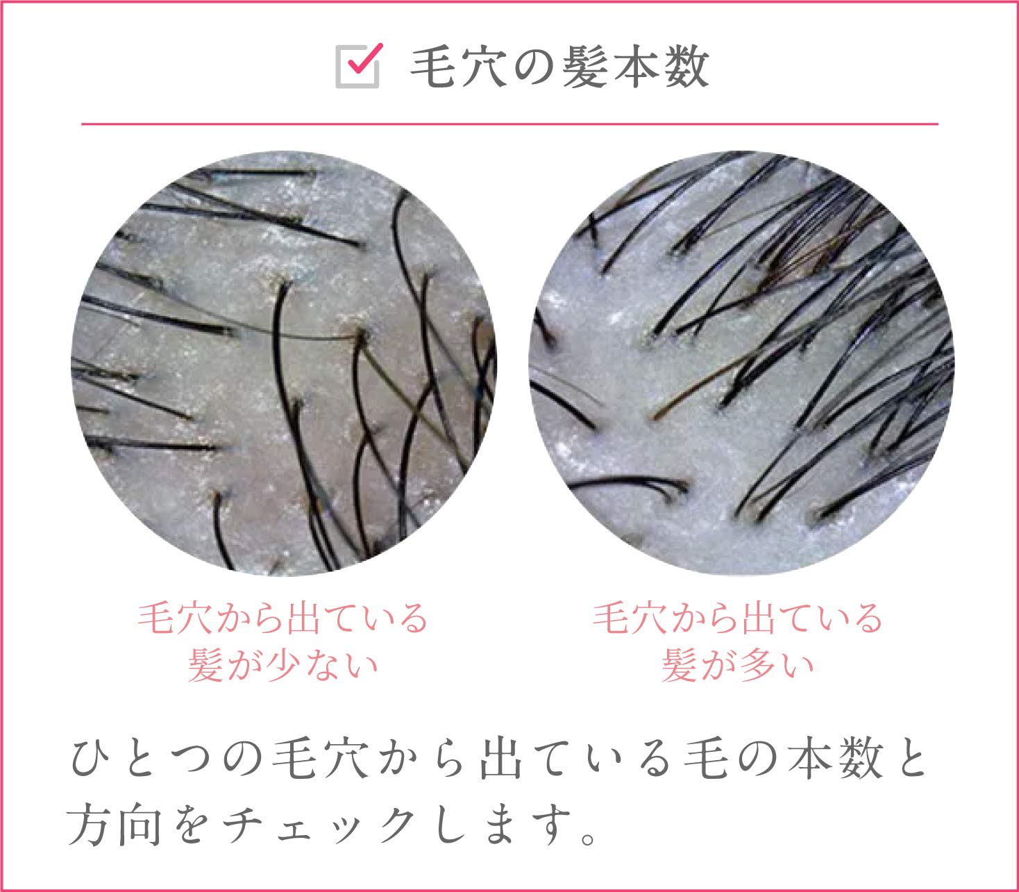 毛穴の髪本数