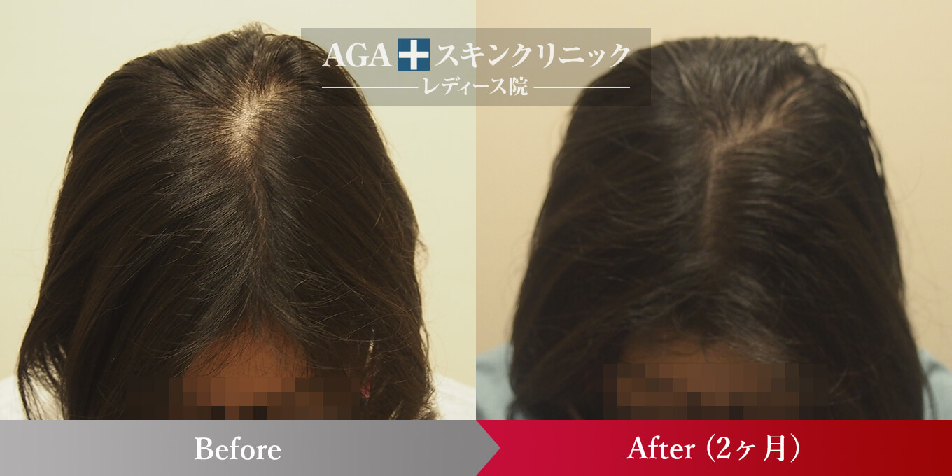 女性型AGA進行度レベル中の症例